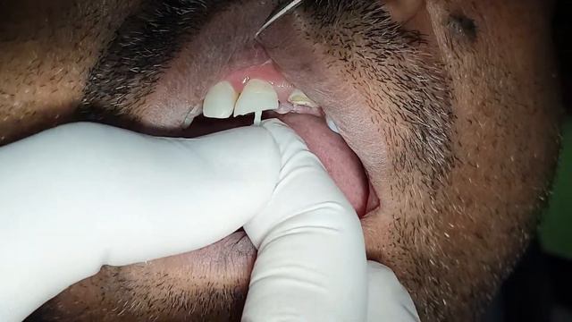 Broken teeth repair | Front teeth ceramic capping | टूटे हुए दांत का इलाज | Post & Core build up. смотреть онлайн