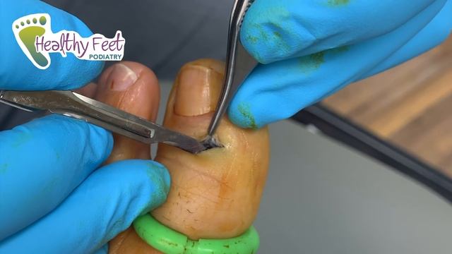 10 YEARS STUCK INSIDE THE FOOT. DOCTOR POPS OUT PENCIL LEAD FROM FOOT смотреть онлайн