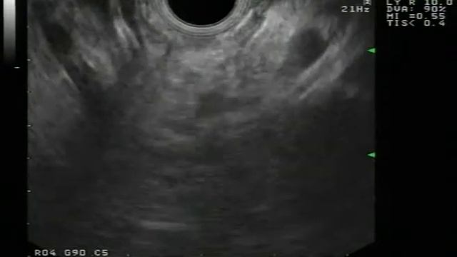 Pancreas: lymph node metastases from pancreatic cancer смотреть онлайн