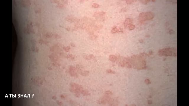 Отрубевидный лишай , лечение , самые действенные методы / цветной лишай , солнечный лишай смотреть онлайн