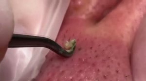 выдавливание прыщей | выдавливание чёрных точек #18