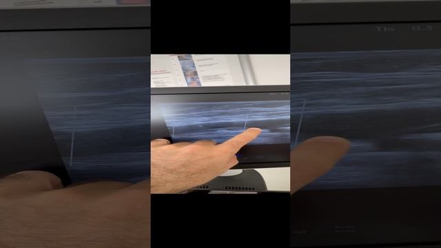 Атеросклероз. Бляшка. Обследование сосудов. Узи сосудов. Сосудистый хирург. Флеболог. Флеболог Москв смотреть онлайн