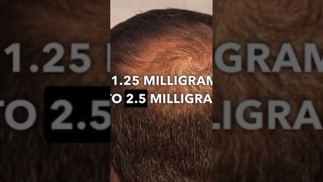 #hairgrowth The Best And Safest Products For Men Hair Loss ? Androgen Alopecia!?