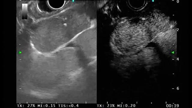 Mediastinum lymph node metastasis 5 смотреть онлайн