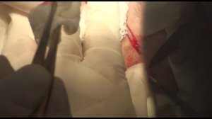 ИССЕЧЕНИЕ РУБЦА