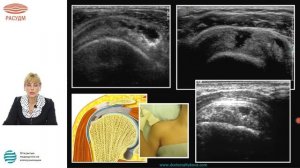 Алгоритм УЗИ плечевого сустава. Стандарты сканирования. Диагностика острой травмы плечевого сустава