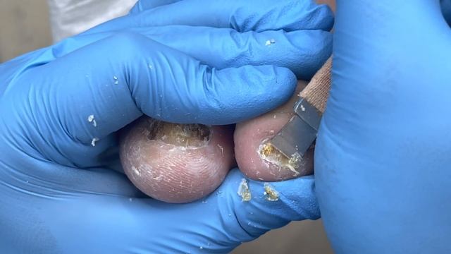 Scraped soft nails, fungus infected nails that turn into skin【Pedicure Master Lin Jun】 смотреть онлайн