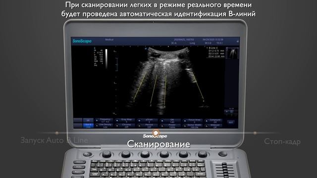 Новый пакет ультразвуковых исследований для оценки легких от SonoScape смотреть онлайн