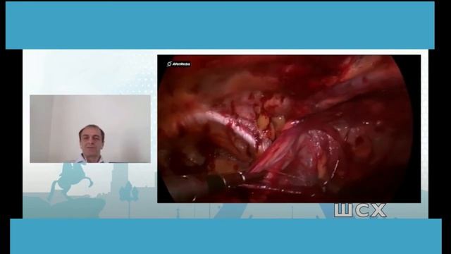 Laparoscopic eTEP inguinal hernia видеолекция полное видео смотреть онлайн