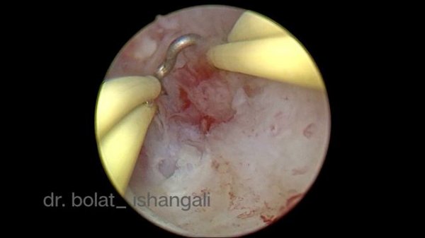 Placental polyp with increased blood flow. Плацентарный полип с усиленным кровотоком.