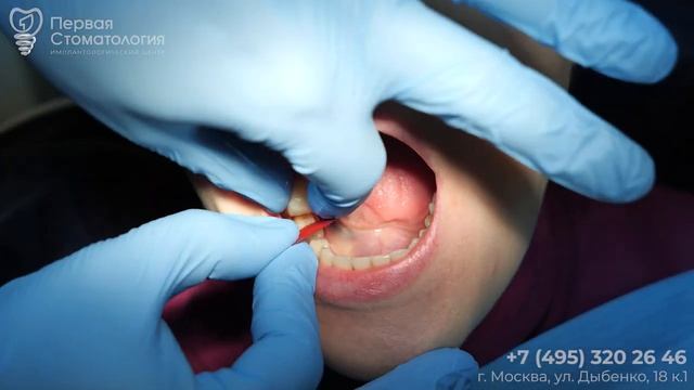 Замена коронок и удаление Восьмёрки. #имплантация #dentist смотреть онлайн