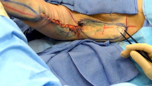 Brachioplasty (Arm Lift Surgery) With Dr. Mark Jabor of El Paso Plastic Surgery смотреть онлайн