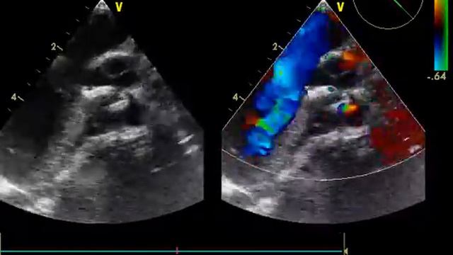 ДМЖП закрыт окклюдером