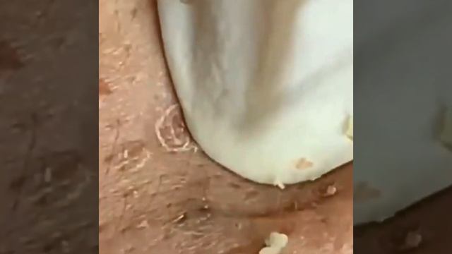 жесткие прыщи смотреть онлайн