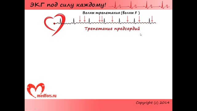 Урок 5. Видеокурс 'ЭКГ