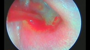 Парацентез барабанної перетинки, Секреторний середній отит, Paracentesis (Glue ear)