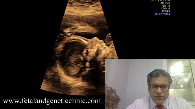 Normal NIPT Aneuploid Fetus смотреть онлайн