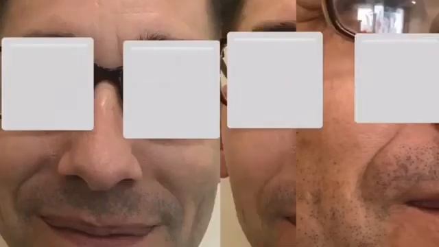 LPG-массаж лица в клинике Эталон, г. Кемерово смотреть онлайн