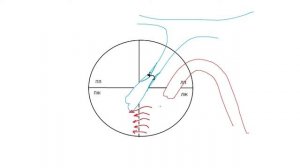 Дефект межжелудочковой перегородки