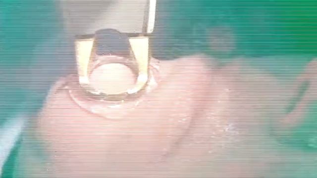Excel V Demonstration Video - Holcomb Facial Plastic Surgery смотреть онлайн