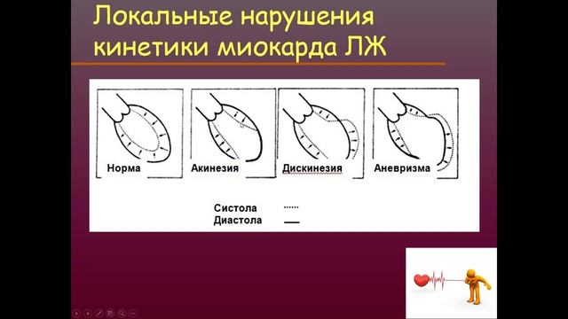 Инфаркт миокарда. Соловьева А.В.