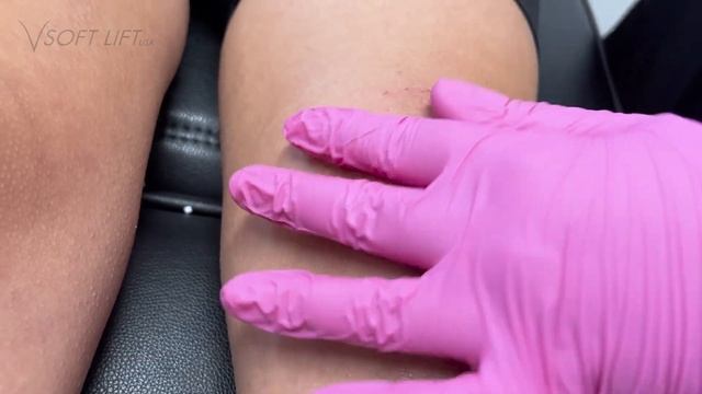 Smooth Threads in the Knees for Collagen Stimulation смотреть онлайн