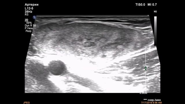 Липосаркома / Liposarcoma