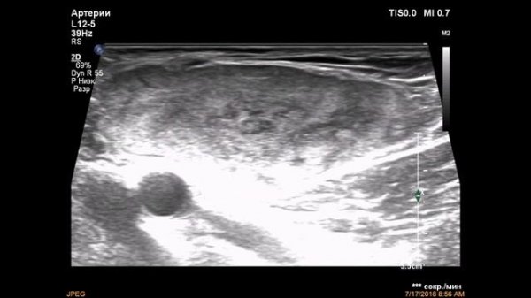 Липосаркома / liposarcoma