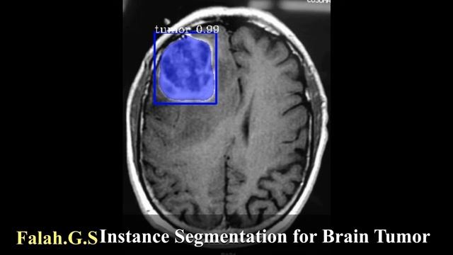 Instance Segmentation System for Human Brain Tumor using Mask R-CNN algorithm смотреть онлайн