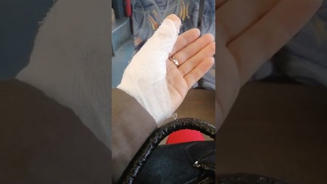 Перелом пальца смотреть онлайн