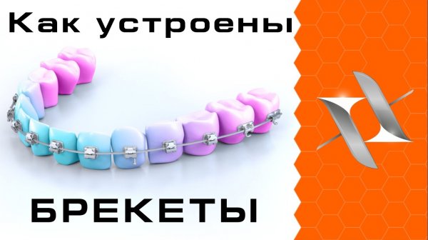 КАК РАБОТАЮТ БРЕКЕТЫ. Устройство брекет-системы.