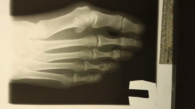 Серия 1. Как правильно фотографировать рентгеновские снимки. смотреть онлайн