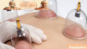 Польза хиджамы.