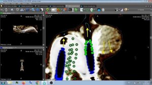 МСКТ КОМПРЕССИОННЫЙ ПЕРЕЛОМ ПОЗВОНКА . ИМПЛАНТЫ .