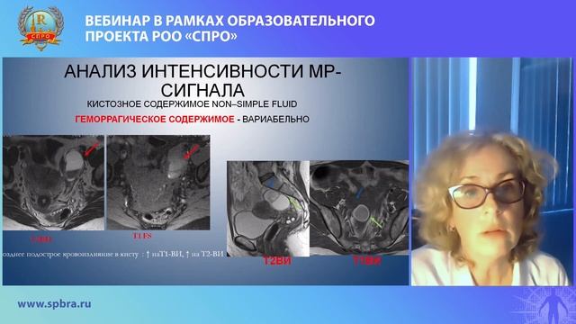 Богданова Е.О. Паттерны МР изображений в дифференциальной диагностике объемных образований яичников смотреть онлайн
