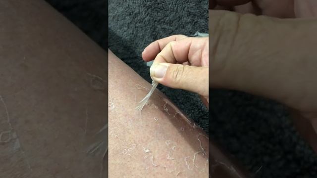 Bad sunburn peeling skin in sheets смотреть онлайн