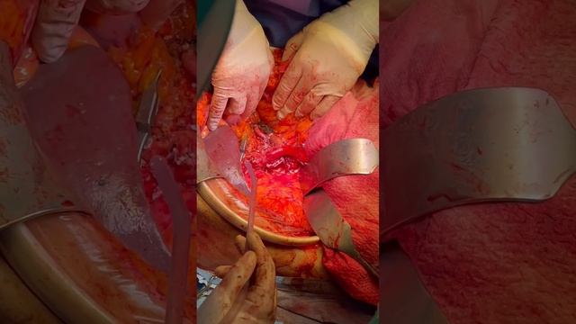 Spleen preserving radical Pancreaticoduodenectomy- resection field view 2 смотреть онлайн