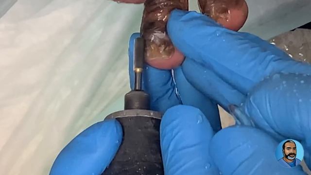 Playing It Safe: Trimming Fungal Toenails For A Patient With Cerebral Palsy смотреть онлайн