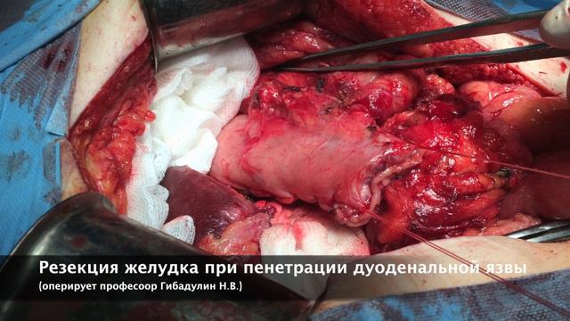 Резекция желудка при пенетрации дуоденальной язвы смотреть онлайн