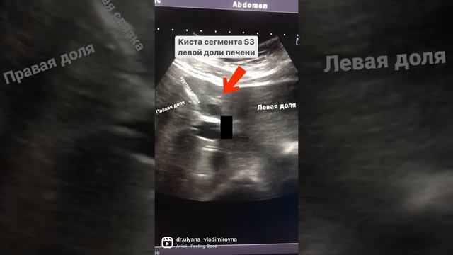 📍Киста сегмента S3 левой доли печени визуализируется как тонкостенное ахогенное образование