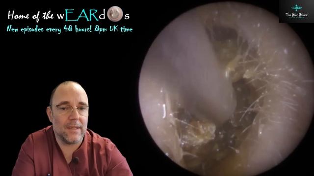 Tympanoplasty 222 #ear #earwax #earwaxremoval #earcleaning #earwaxclinic #asmr #satisfying