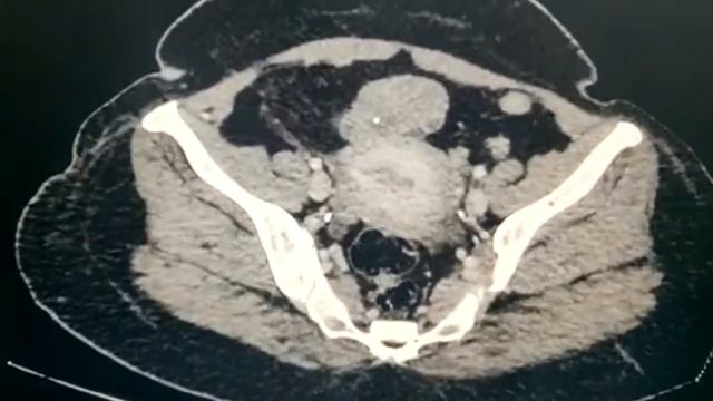 TORSION OF THE LEFT ADNEXA|TORSION DUE TO CYSTIC LESION IN THE ADNEXA|ACUTE PELVIC PAIN| DAILY RAD смотреть онлайн
