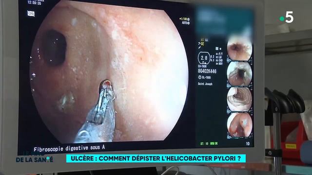 Ulcère : comment dépister l'helicobacter pylori ? - Le Magazine de la Santé смотреть онлайн