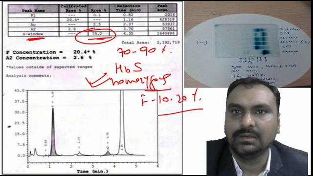 Interpretation of HPLC reports for Hemoglobinopathies смотреть онлайн