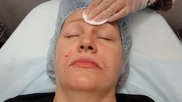 Обучение косметологов , мастер-класс проводит Врач дерматолог - косметолог Хуснутдинова Н.В. смотреть онлайн