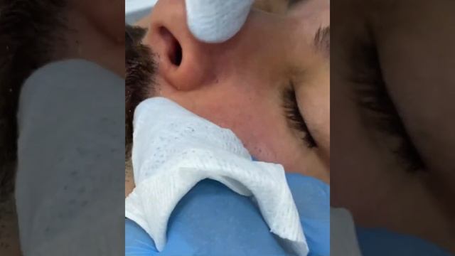 Комбинированная чистка лица. смотреть онлайн