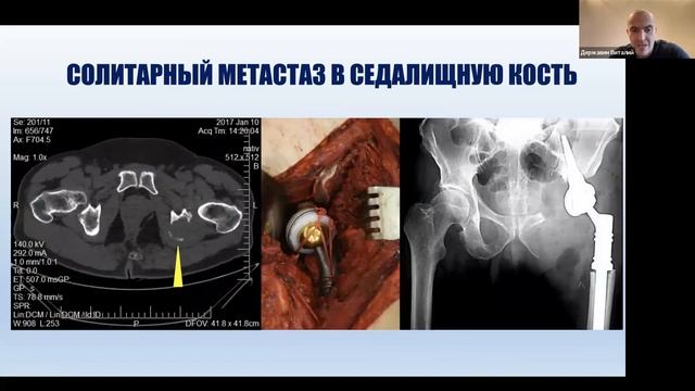 Возможности хирургического лечения у пациентов с метастазами рака почки в кости (Державин В.А. )