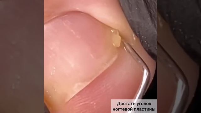 Кюретка для вросшего ногтя смотреть онлайн