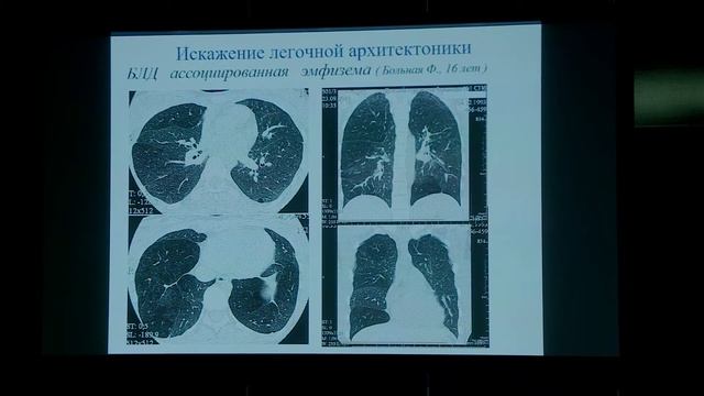 Ильина Н.А. – Интерстициальные изменения в лёгких детей, обусловленные бронхолёгочной дисплазией