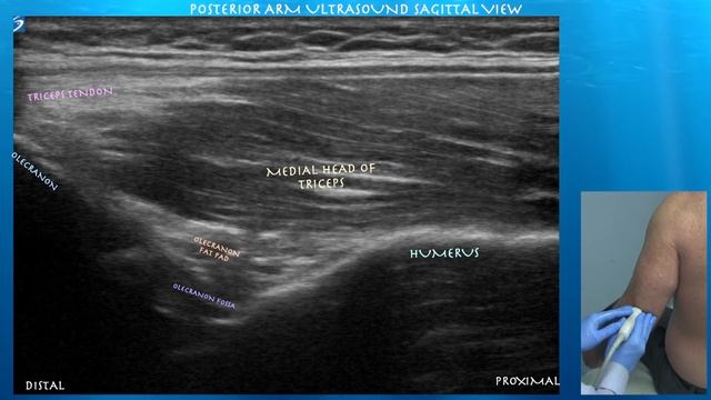 Ultrasound of Normal Triceps Anatomy...by probeultasound.com смотреть онлайн